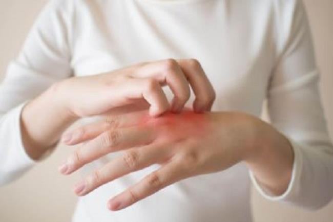 אישה מגרדת את גב כף היד, קטוקונאזול לטיפול בזיהום פטרייתי בעור